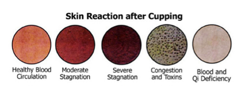 skin reaction from cupping